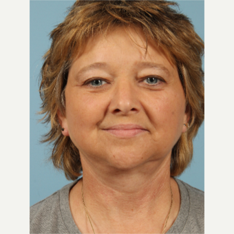 55-64 year old woman treated with Facelift after 3617660
