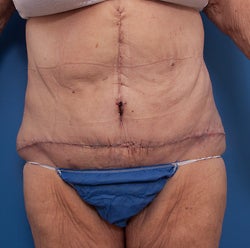 Body Lift after 849810