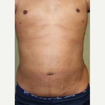 Liposuction Revision after 2132872