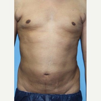 Liposuction Revision before 2132872