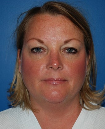 Liposuction and Limited Neck Lift before 1181640