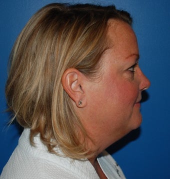 Liposuction and Limited Neck Lift 1181640