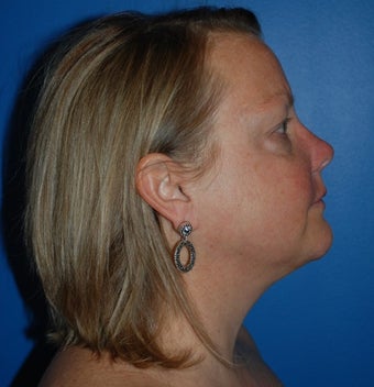 Liposuction and Limited Neck Lift 1181640