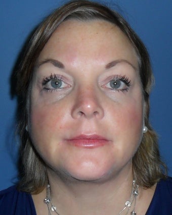 Liposuction and Limited Neck Lift after 1181640