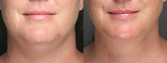 SmartLipo Liposuction of Neck before 275620