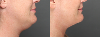 SmartLipo Liposuction of Neck after 275620