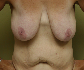 Mommy Makeover: included a breast lift with implants and a tummy tuck before 1340665