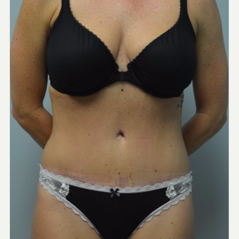 25-34 year old woman treated with Tummy Tuck after 3093630