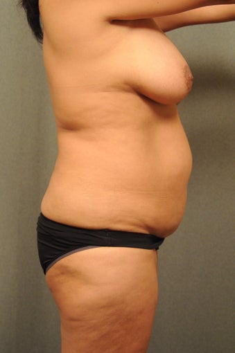 52 Year Old Female Having a Mommy Makeover 938771
