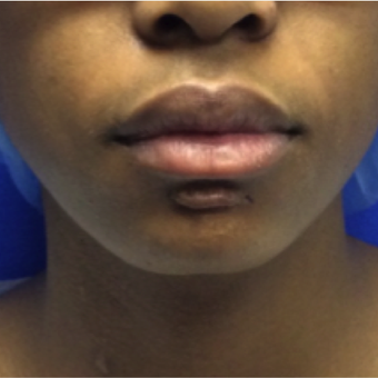 19 year old woman - keloid removed from chin before 1744974