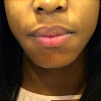 19 year old woman - keloid removed from chin after 1744974