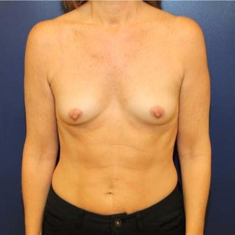 50 year old woman treated with Breast Augmentation before 1881284