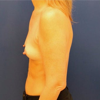 50 year old woman treated with Breast Augmentation 1881284