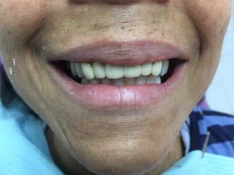 Hybrid Prosthesis after 2752716