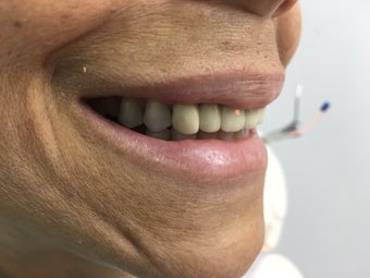 Hybrid Prosthesis 2752716