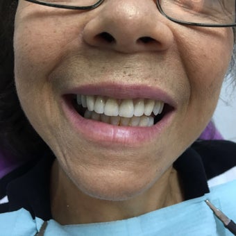 Hybrid Prosthesis before 2752716