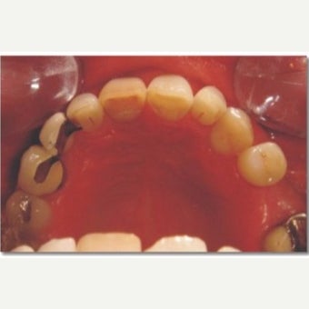 45-54 year old man treated with Invisalign after 2576159