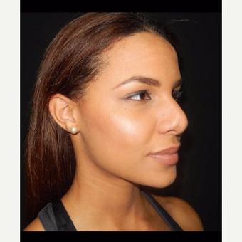 25-34 year old man treated with Rhinoplasty before 3390190