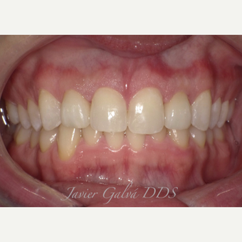 Peg laterals and yellow teeth treated with Porcelain Veneers after 3119873