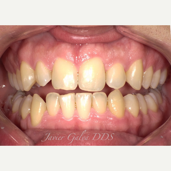 Peg laterals and yellow teeth treated with Porcelain Veneers before 3119873