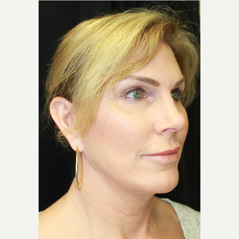 45-54 year old woman treated with Rhinoplasty before 3741499
