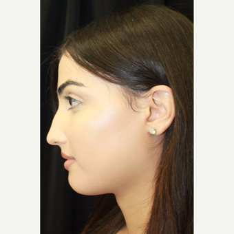 18-24 year old woman treated with Facial Feminization Surgery after 2747175