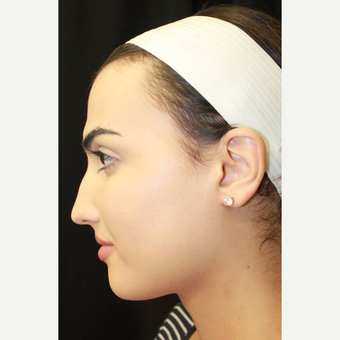 18-24 year old woman treated with Facial Feminization Surgery before 2747175