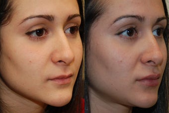 Permanent Lip Augmentation with Silikon-1000 before 1327146