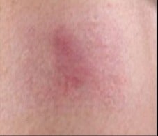 18-24 year old woman treated with Scar Removal after 2019600
