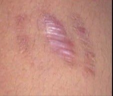 18-24 year old woman treated with Scar Removal before 2019600