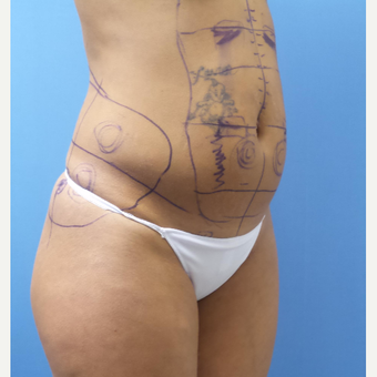 35-44 year old woman treated with Smart Lipo before 3097235