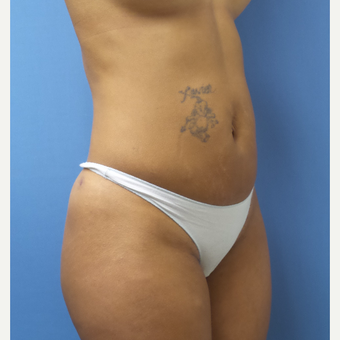 35-44 year old woman treated with Smart Lipo after 3097235