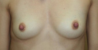 Breast Reconstruction before 517496