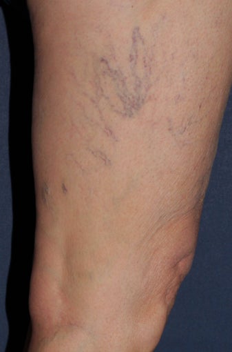 62 year old female treated with Sclerotherapy for Leg Veins before 986761