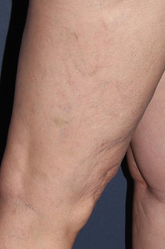 62 year old female treated with Sclerotherapy for Leg Veins after 986761