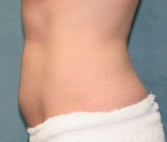 Coolsculpting after 374890