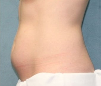 Coolsculpting before 374890