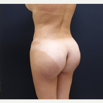 35-44 year old woman treated with Butt Augmentation after 3234489