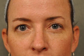 41 Year Old Female with Under Eye Shadows after 975039