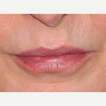 58 year old woman treated with Lip Augmentation after 1957192