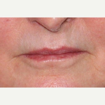 58 year old woman treated with Lip Augmentation before 1957192