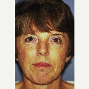 45-54 year old woman treated with Facelift before 3749121