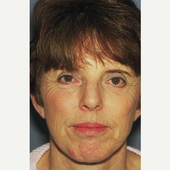 45-54 year old woman treated with Facelift after 3749121