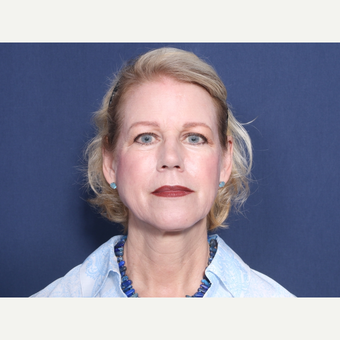 55-64 year old woman treated with Neck Lift (view 1 of 2) before 3175516