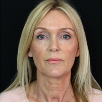 45-54 year old woman treated with Lower Face Lift before 2877971