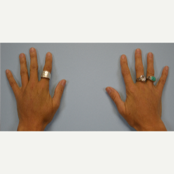 Hand Rejuvenation - Fat Transfer to Hands after 3465765