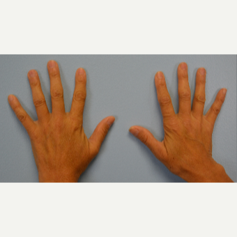 Hand Rejuvenation - Fat Transfer to Hands before 3465765