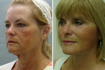 Mid Face Cheek Lift before 1360164