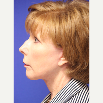 59 year old woman treated with Lower Face and Neck Lift after 3419648