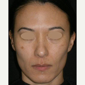 35-44 year old woman treated with Laser Treatment before 3128202